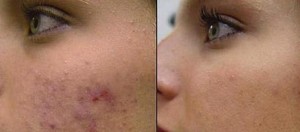 Before and After Acne Facial Scarring 