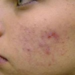 acne scar