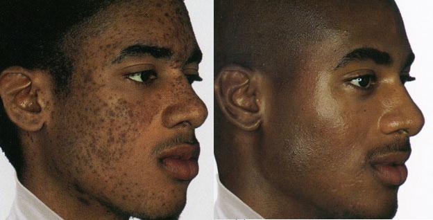 African American Youth Facial Scars Removed with Chemical Peel Treatments