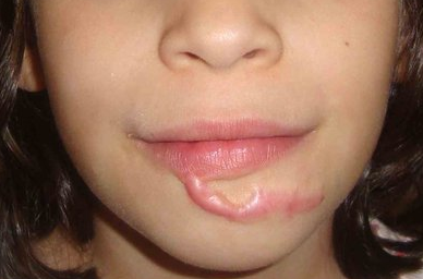 Facial Scar on Young Girl