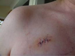 Mole removal surgery scar prevention 