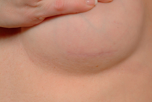 Scarring after breast surgery.