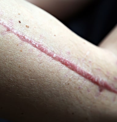 Learn how scars are formed and natural methods to treat them