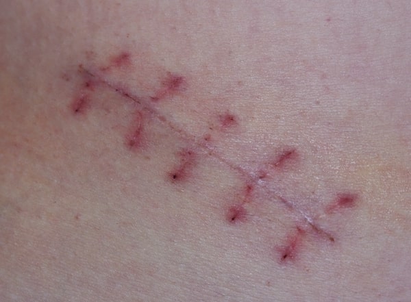 Surgical Scars how to avoid them