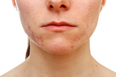 Adult female acne